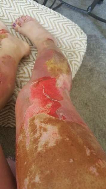 Sarnia burn victim Noelle Frank (Submitted Photo)