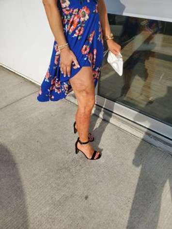Sarnia burn victim Noelle Frank (Submitted Photo)