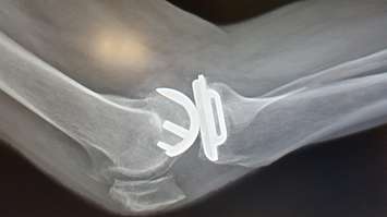 X-ray image of a knee replacement. Photo courtesy of SimplySO via MorgueFile.